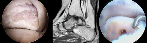 Ankle Arthroscopy