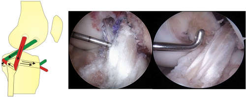 Knee Ligament Injuries