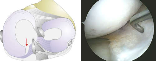 Meniscus Surgery